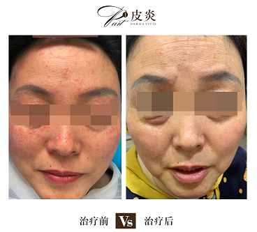 海口哪家治疗皮肤过敏较好